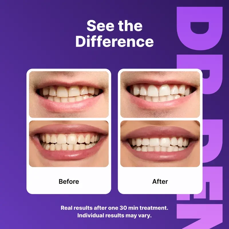 Peroxide-Free Purple Teeth Whitening Strips
